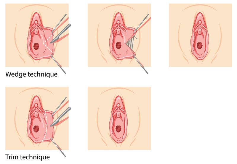 Illustration-of-labiaplasty-procedure