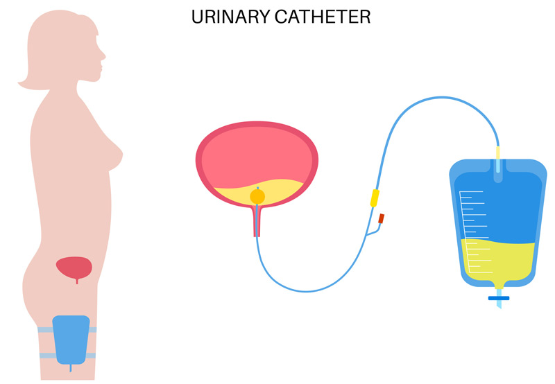 Illustration-of-urinary-catheter-for-urinary-incontinence