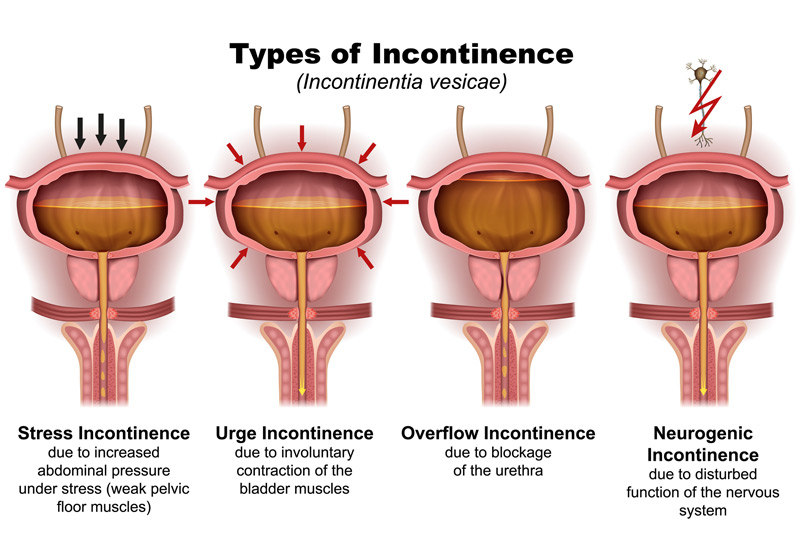 Illustration-of-various-types-of-urinary-incontinence
