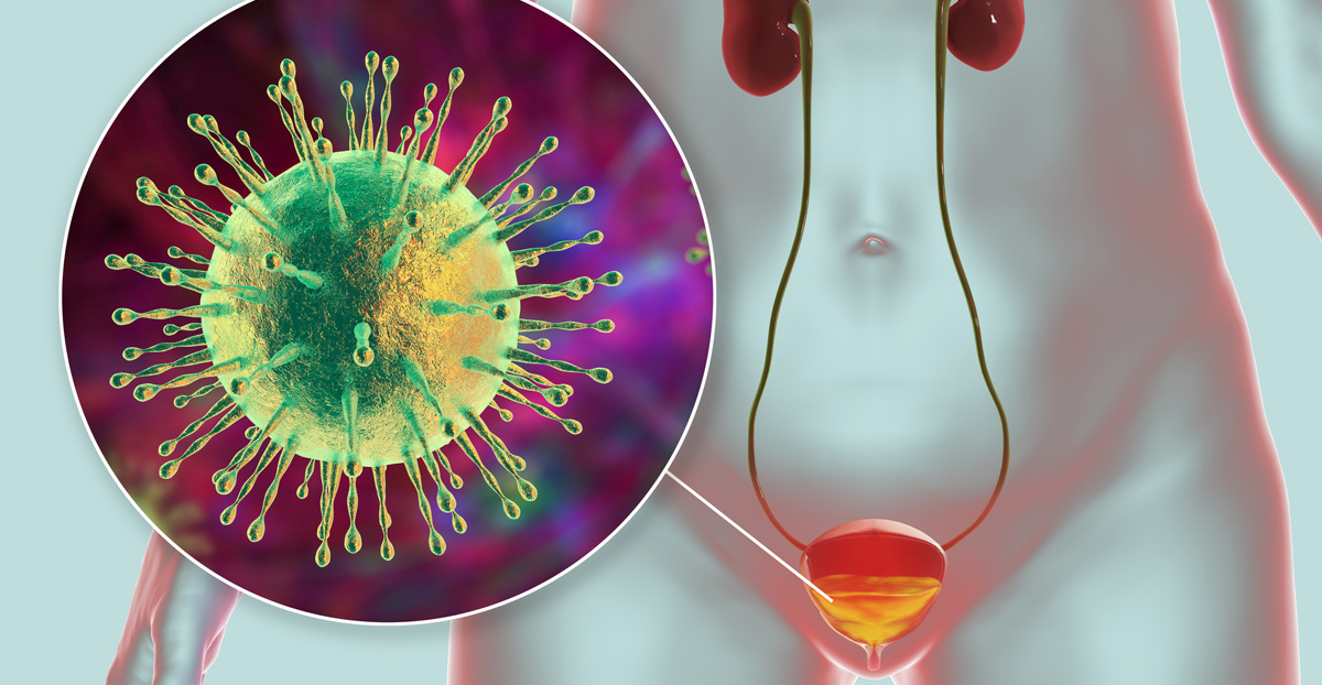illustration-of-a-viral-cystitis-infection