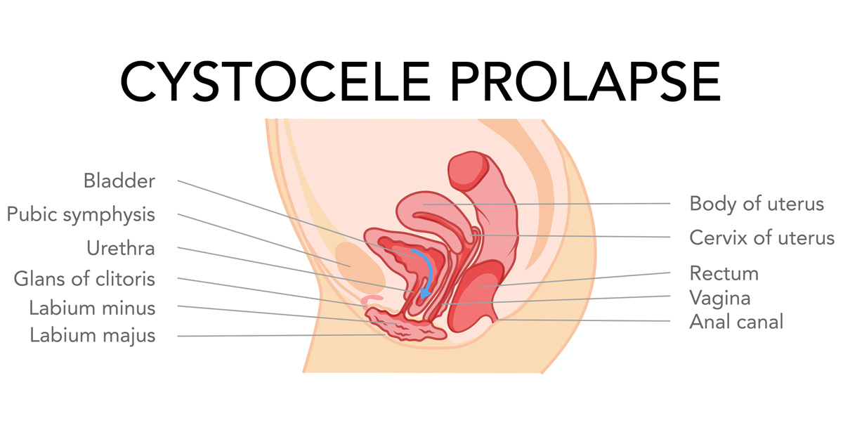 illustration-of-cystocele-prolapse