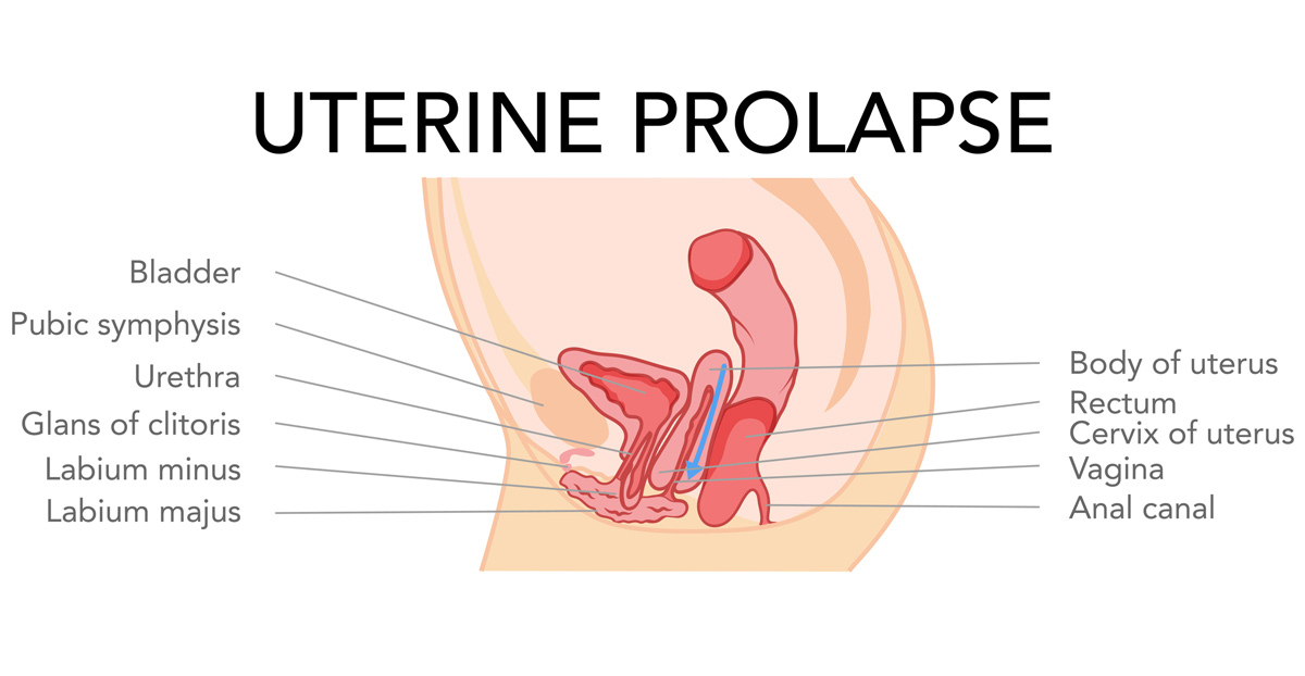 illustration-of-pelvic-organ-prolapse-type