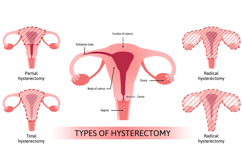 illustration-of-the-types-of-hysterectomy