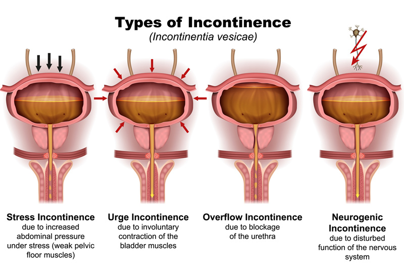 illustration-of-types-of-incontinence