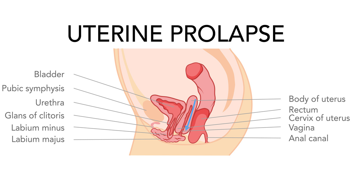 illustration of uterine prolapse