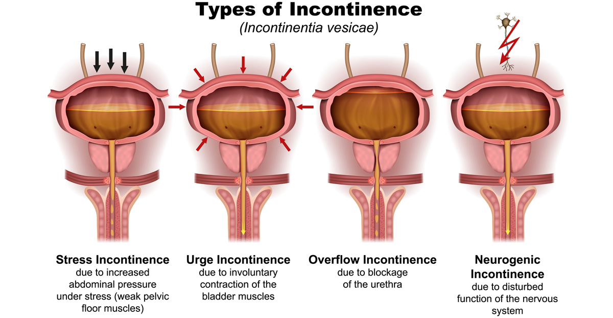 medical-illustration-showing-types-of-incontinence